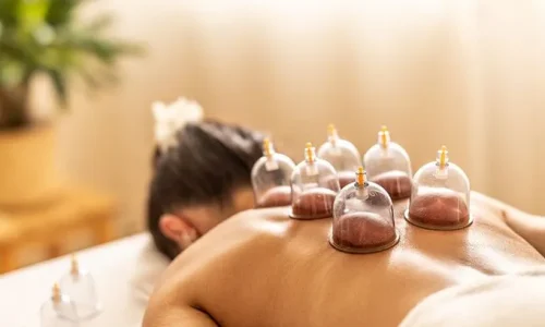 coupping therapy